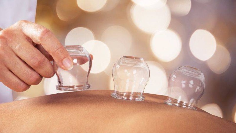 Kupa terapisi uygulaması sırasında sırta yerleştirilen şeffaf vakumlu kupalar – geleneksel tamamlayıcı tıp yöntemi