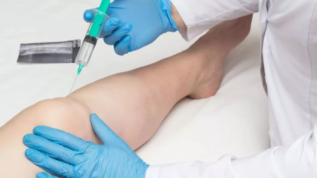 Proloterapi tedavisi sırasında enjeksiyon yapılan bir diz eklemi görüntüsü