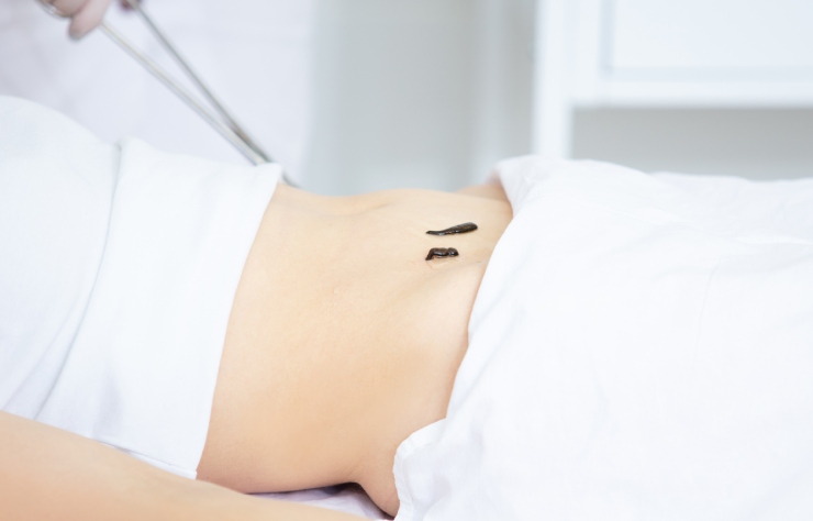 Steril ortamda hastanın bacağına uygulanan sülük tedavisi – geleneksel tamamlayıcı tıp uygulaması olan hirudoterapi